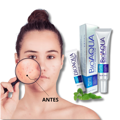 🌿CREMA ANTIACNÉ BIOAQUA💆‍♀️ Reduce Granos, Inflamación y Poros en pocos días”